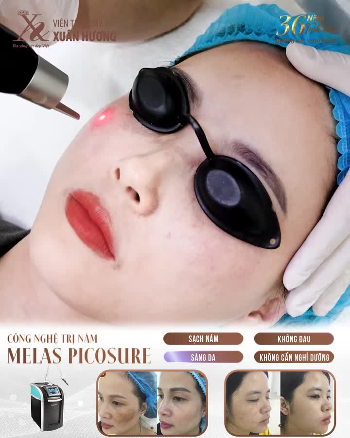 Ưu điểm vượt trội của công nghệ trị nám Melas PicoSure tại VTM Xuân Hương