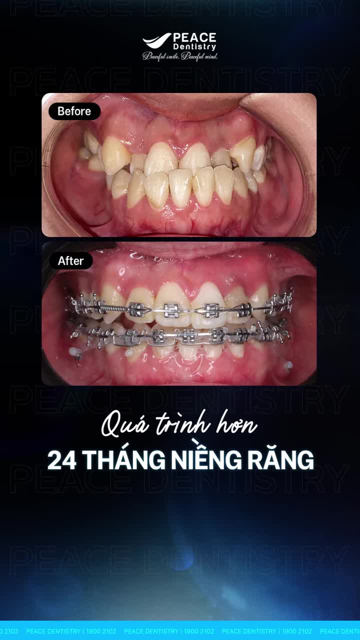 Khoảnh khắc "lột xác" ngoạn mục của khách hàng sau 2 năm kiên trì niềng răng.