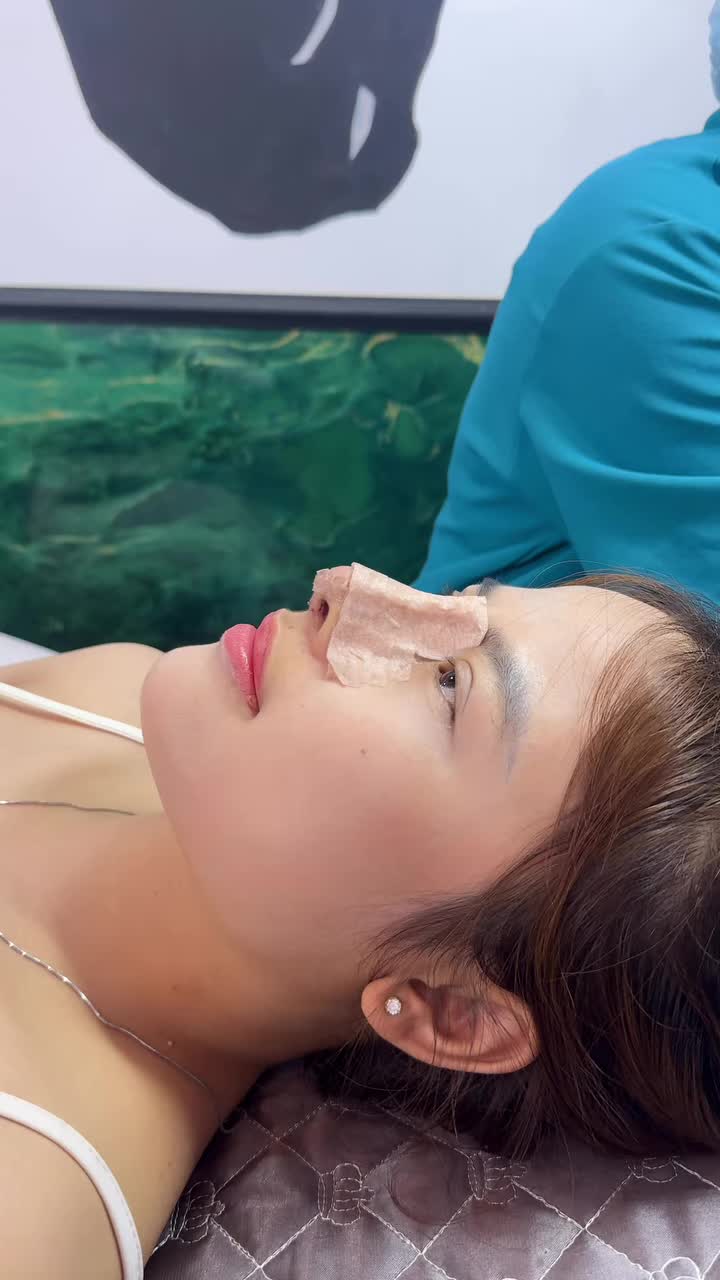 Cắt chỉ 10 ngày mũi cấu trúc sụn Surgiform sửa lại