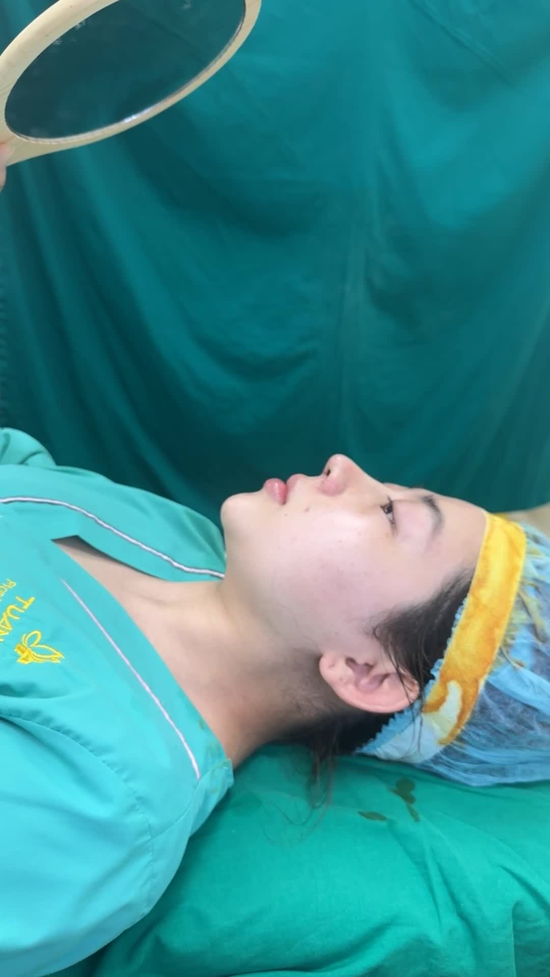 Case Mũi cấu trúc Surgiform vừa hoàn thành - Dáng mũi hài hòa, tự nhiên mà vẫn thanh tú, sắc nét!!