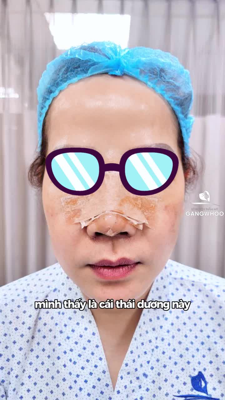 Độn thái dương: Thay đổi nhỏ nhưng khác biệt lớn