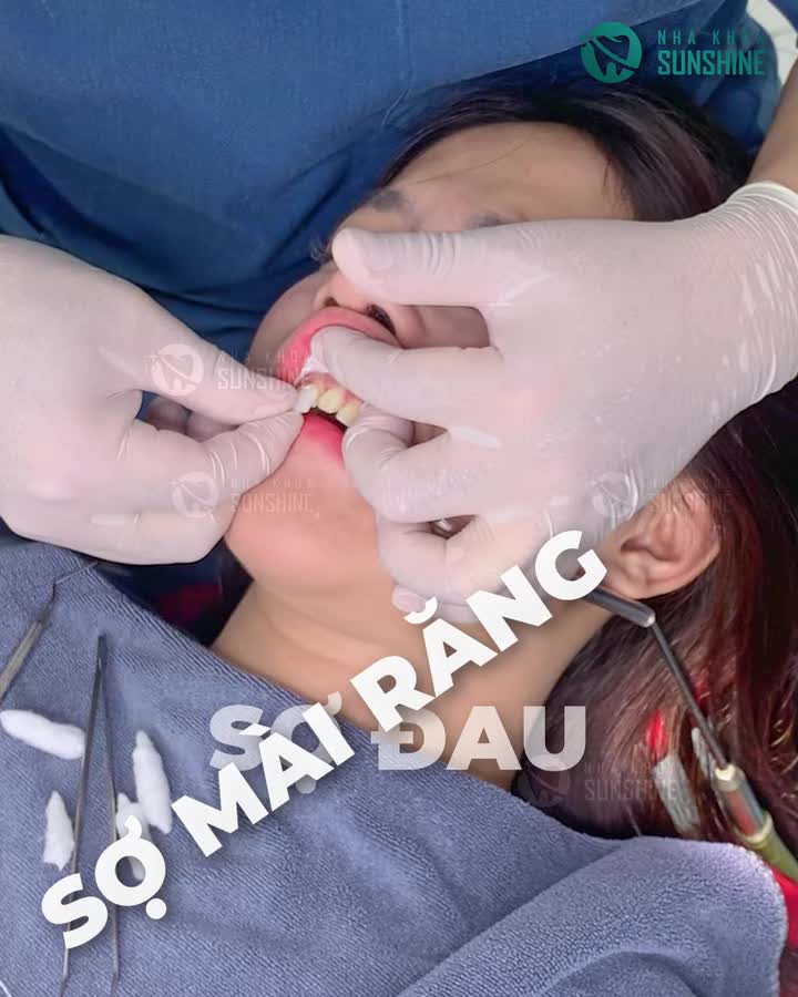 Muốn cải thiện nụ cười nhưng sợ đau - sợ mài răng Chị Mai Trang quyết định lựa chọn phương pháp dán sứ Veneer.