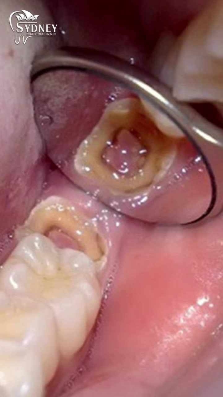 Răng Khôn Bị Sâu: Có nên trám răng hay phải nhổ?