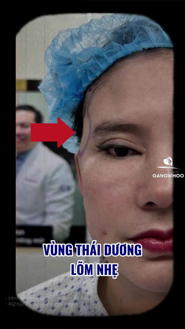 Trước phẫu thuật tạo hình vùng mặt thiểu sản (độn thái dương): tình trạng vùng thái dương hơi lõm, tạo cảm giác khuôn mặt chưa cân đối