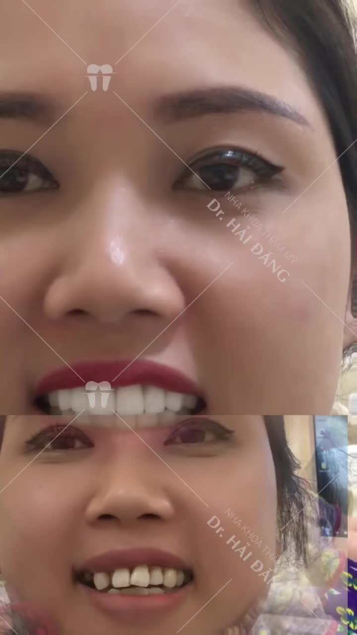 Răng khấp khểnh, hô.. biến hình sau 24 giờ thay đổi ngoạn mục được mô tả bằng video dưới đây