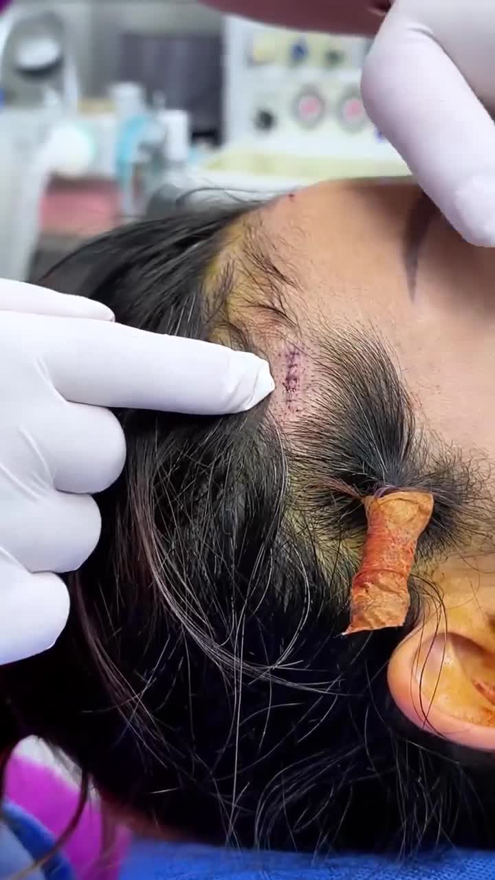 CHỊ KHÁCH HÀNG RẠNG NGỜI SAU ĐỘN THÁI DƯƠNG – BÁC SĨ PHÂN TÍCH CẢI THIỆN TRỰC TIẾP TẠI PHÒNG MỔ TẠI GANGWHOO!