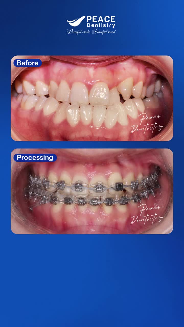 Niềng răng không chỉ giúp cải thiện thẩm mỹ mà còn khắc phục các vấn đề về khớp cắn, sắp xếp lại răng đúng vị trí và hỗ trợ sức khỏe răng miệng lâu dài.