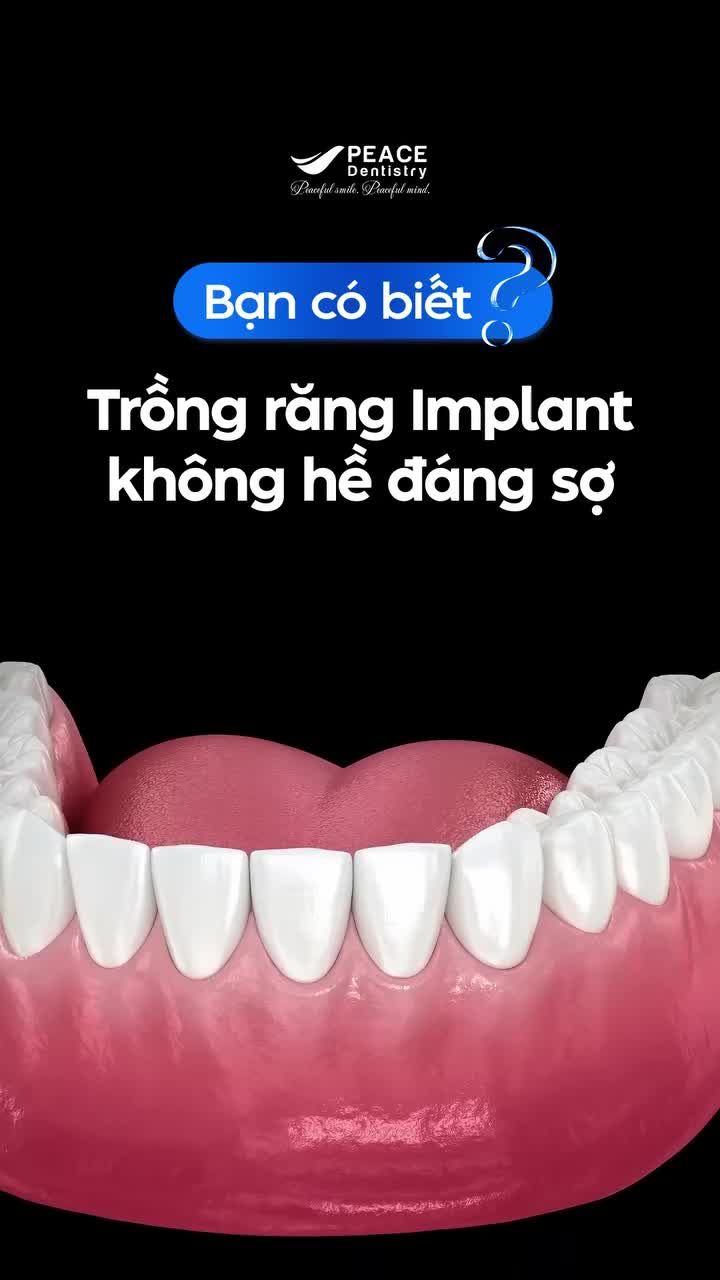 Nhiều người lo lắng khi thấy quy trình trồng Implant phải “khoan vào nướu và xương” để đặt trụ.