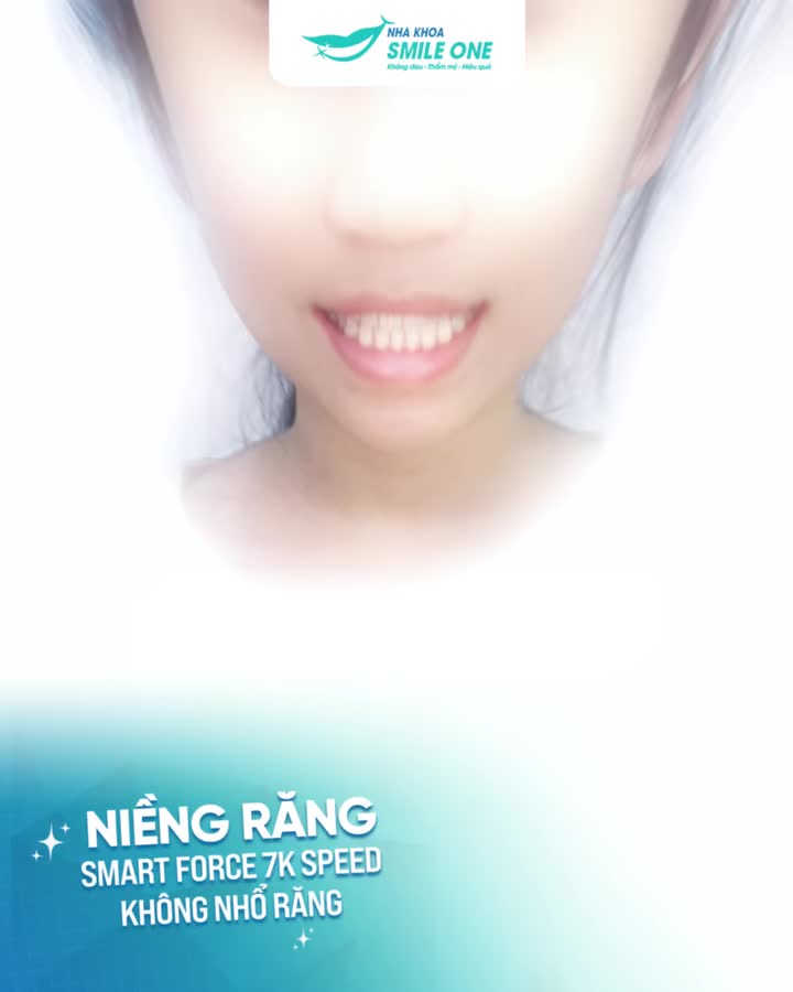 Chào các cô chú nhé, con tháo niềng, con xinh trước đây Hi vọng các cô chú cũng sớm được tháo niềng như con