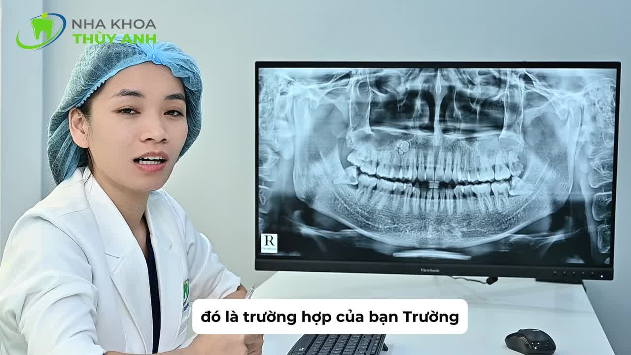 XỬ LÝ 4 CHIẾC RĂNG KHÔN GÂY ĐAU NHỨC - QUYẾT ĐỊNH GIÚP TRƯỜNG TÌM LẠI SỰ THOẢI MÁI TRONG SINH HOẠT HÀNG NGÀY