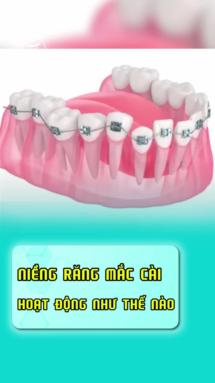 10 giây để biết cơ chế hoạt động của niềng răng mắc cài cùng Nha khoa Smile One nào cả nhà!