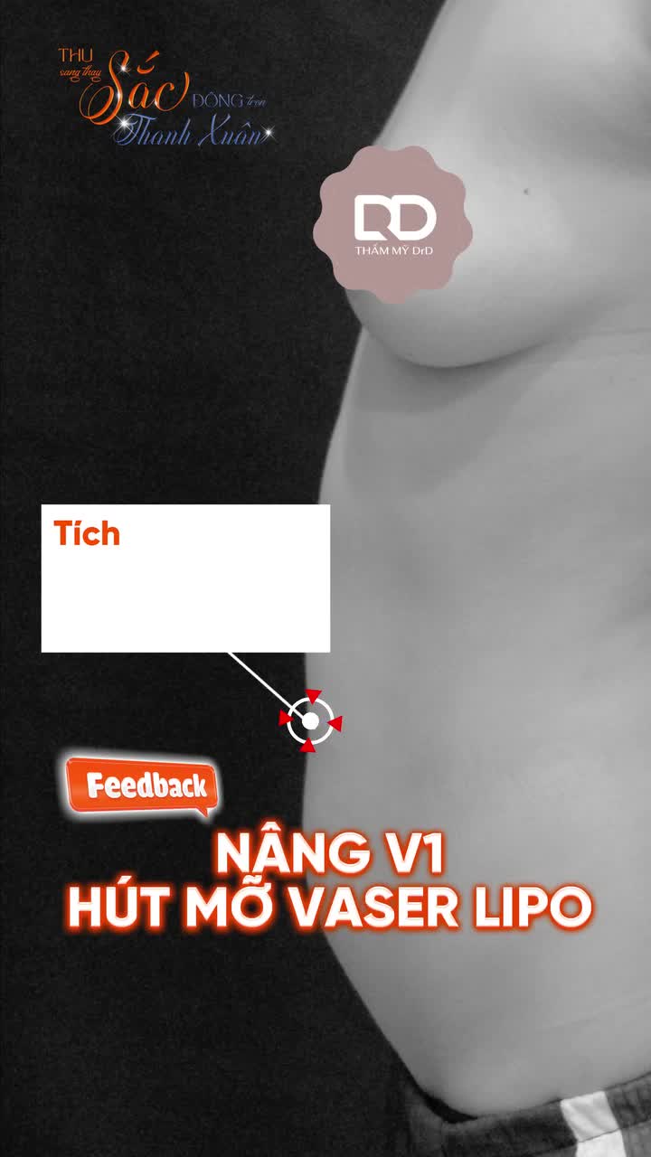 Chị khách Việt Kiều “lột xác” sau combo Nâng cấp V1 + Hút mỡ Vaser Lipo tại Bác sĩ Điền !