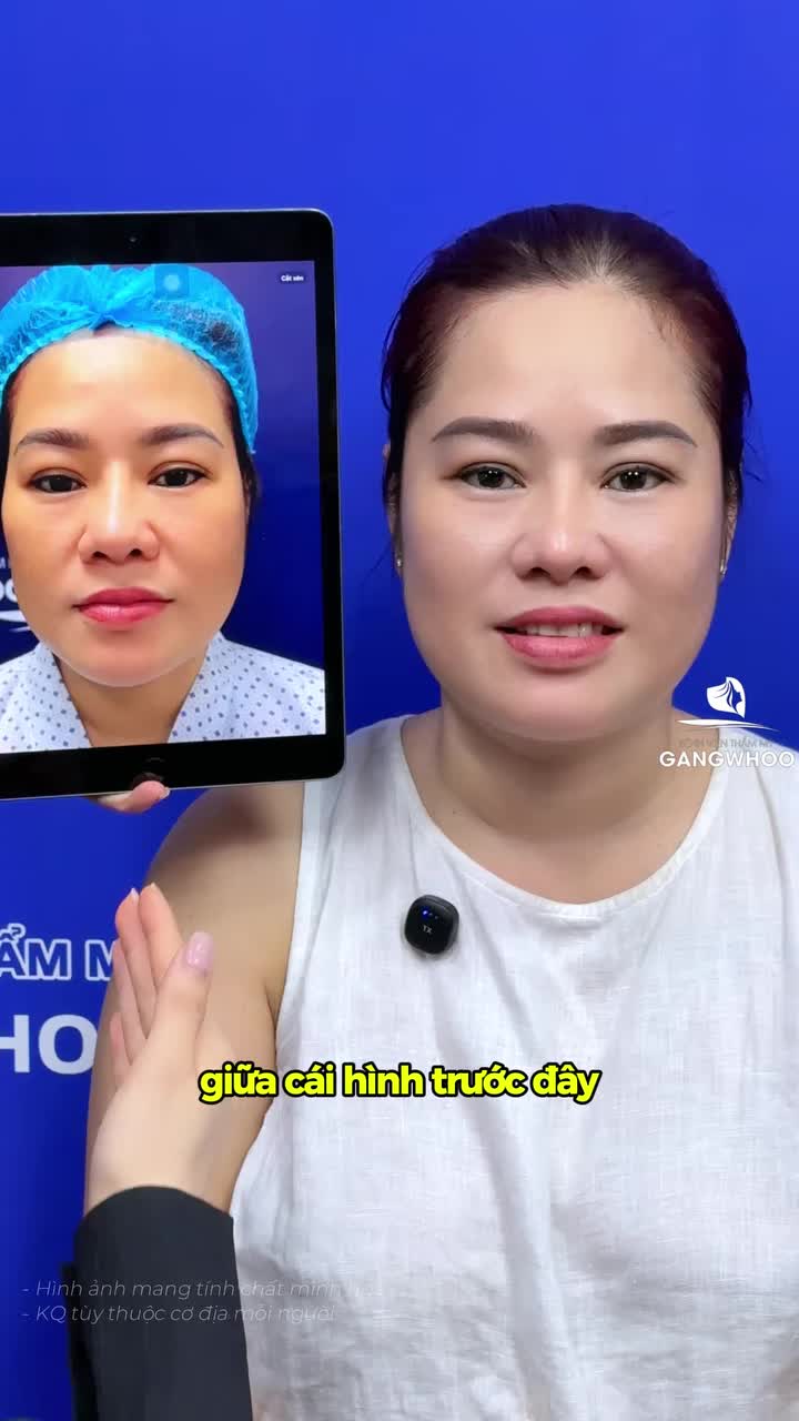 Chị từng sợ gương mặt thiếu cân đối, cười nói cũng mất tự tin, và chị chọn BVTM Gangwhoo độn thái dương, đây là kết quả sau 14 ngày: Gương mặt hài hòa – tự nhiên