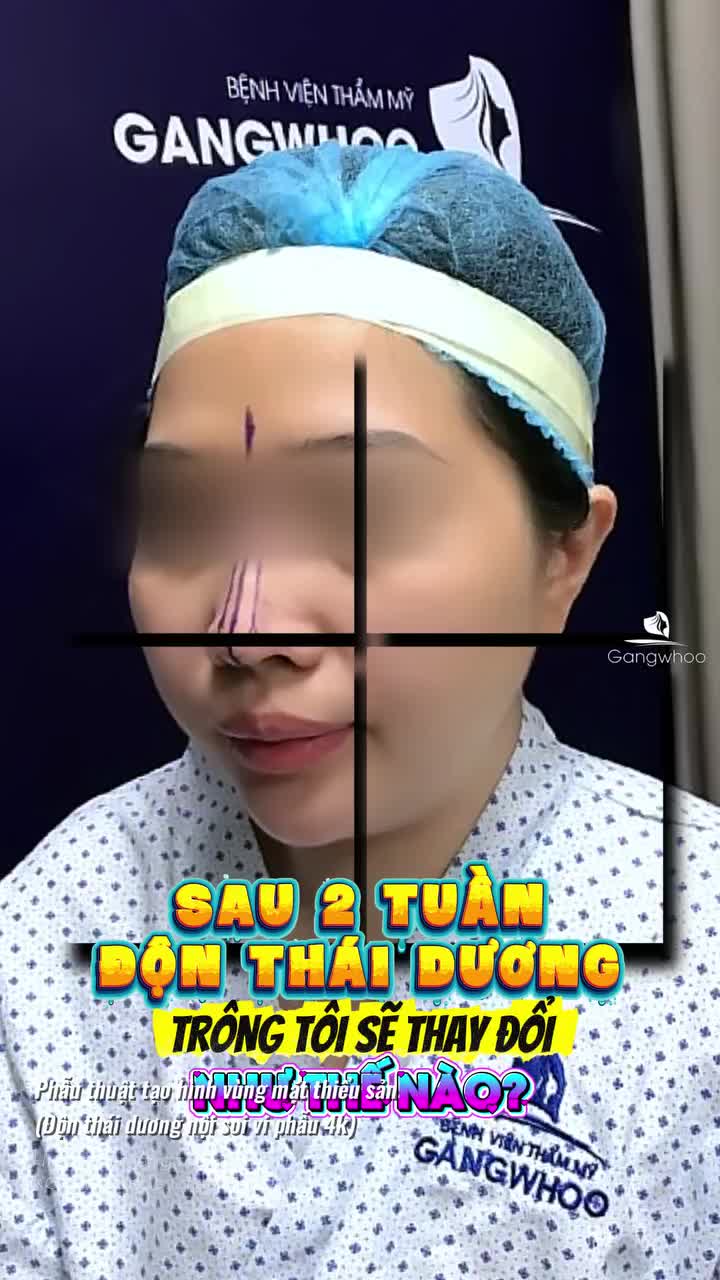 DMKT: phẫu thuật tạo hình vùng mặt thiểu sản Độn thái dương nội soi 4K