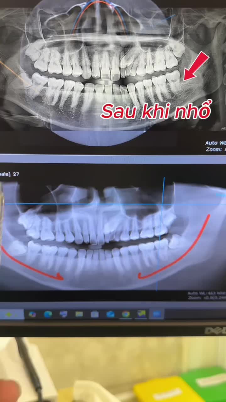 Răng khôn mọc lệch 80 độ Nhổ sớm để tránh biến chứng nguy hiểm