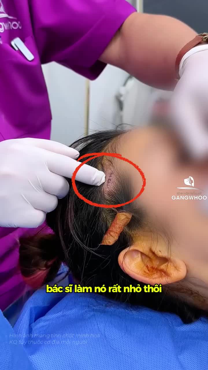 Từ những phút đầu, gương mặt đã bắt đầu vào form, đường nét đầy đặn hơn nhìn rất rõ.