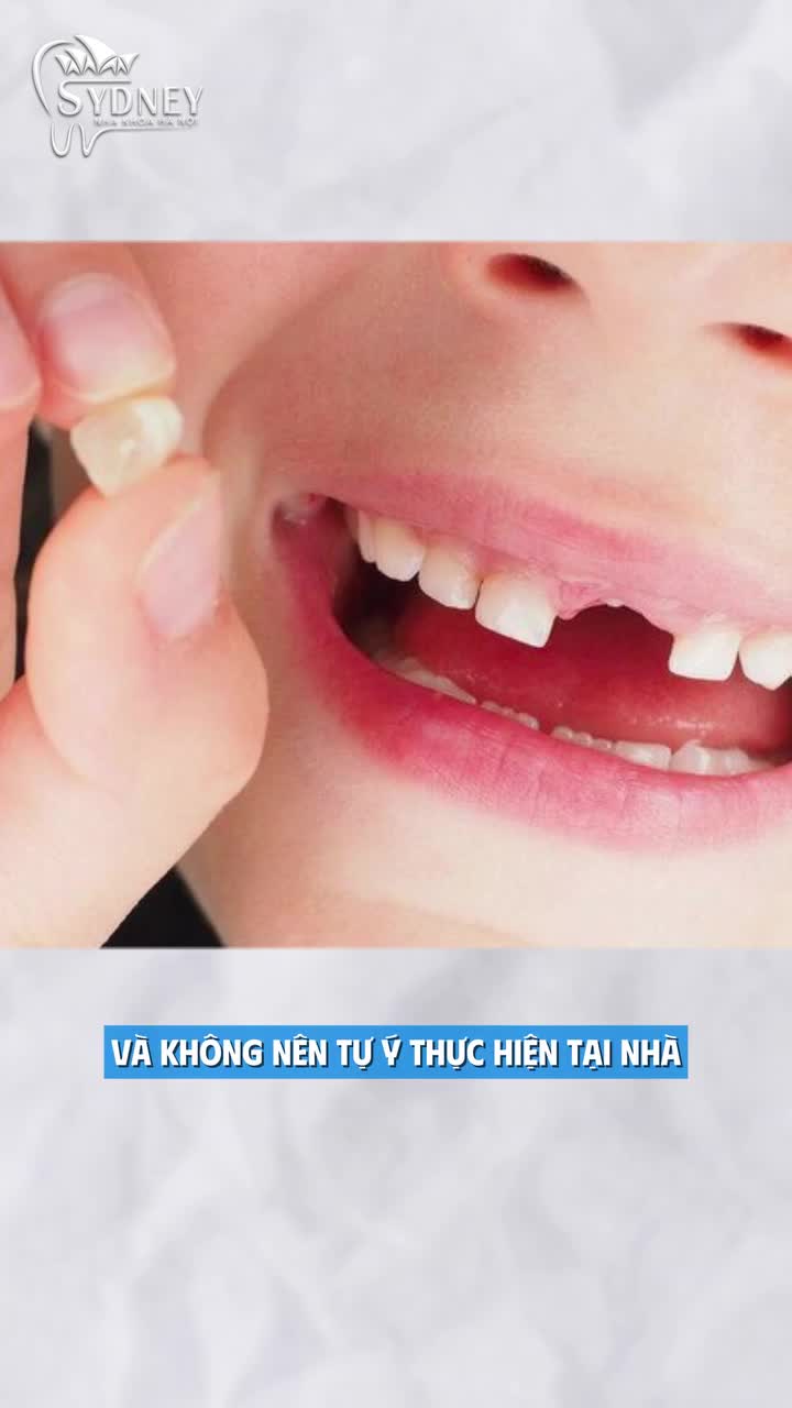 Có nên nhổ răng sữa cho trẻ?
