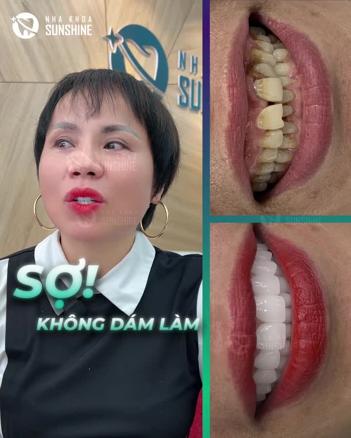 TRƯỚC KHI LÀM RĂNG SỨ NHƯNG SỢ BUỐT - SỢ ĐAU KHÔNG DÁM LÀM, NHƯNG SAU KHI TRỰC TIẾP TRẢI NGHIỆM, KẾT QUẢ LÀ