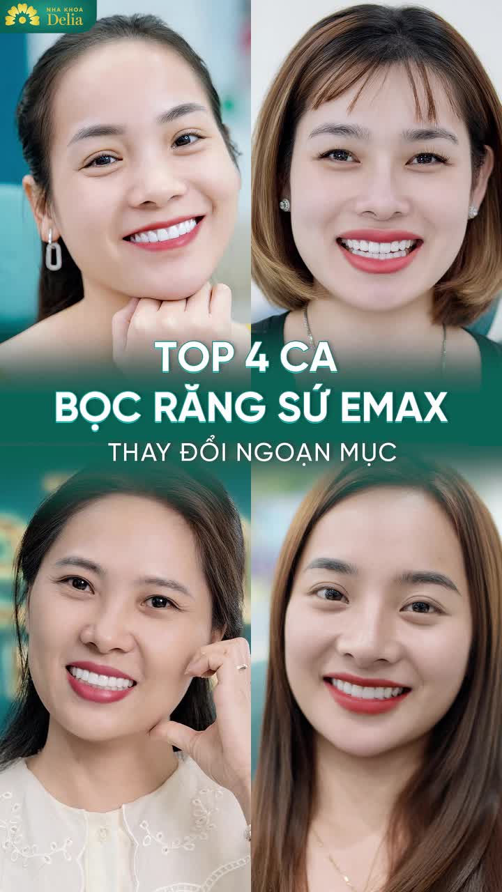 Điểm danh Top 4 ca Làm Răng Sứ Emax thay đổi ngoạn mục Check ngay!