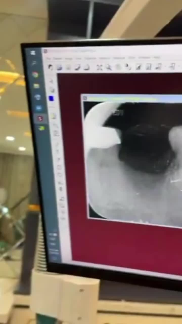 Ca trồng răng implant