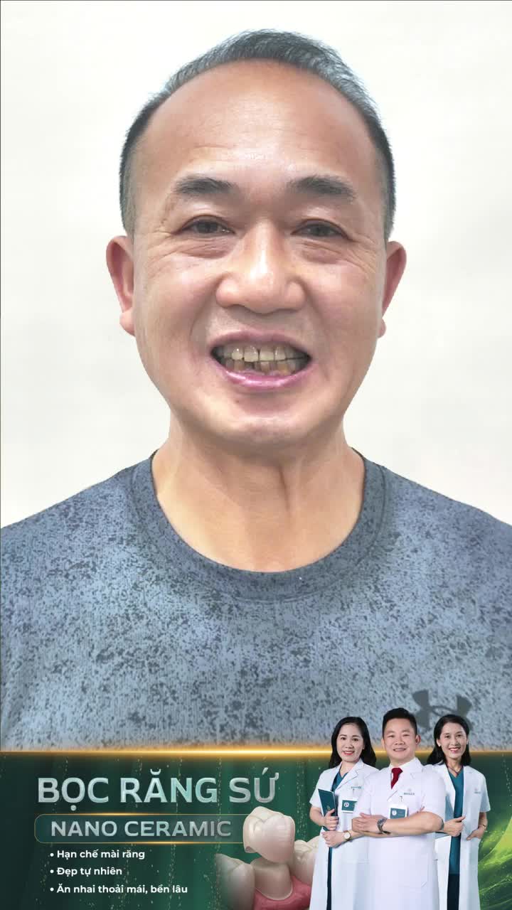 Anh Thắng - người Mỹ gốc Việt - đã thay đổi thế nào sau bọc răng sứ