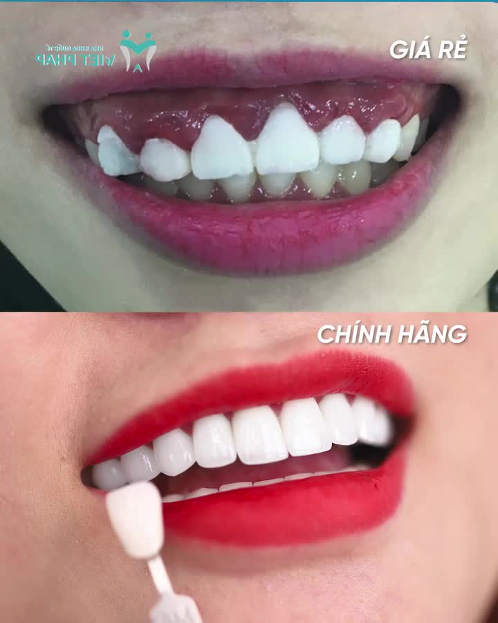 RĂNG SỨ GIÁ RẺ CÓ THẬT SỰ "RẺ"?
