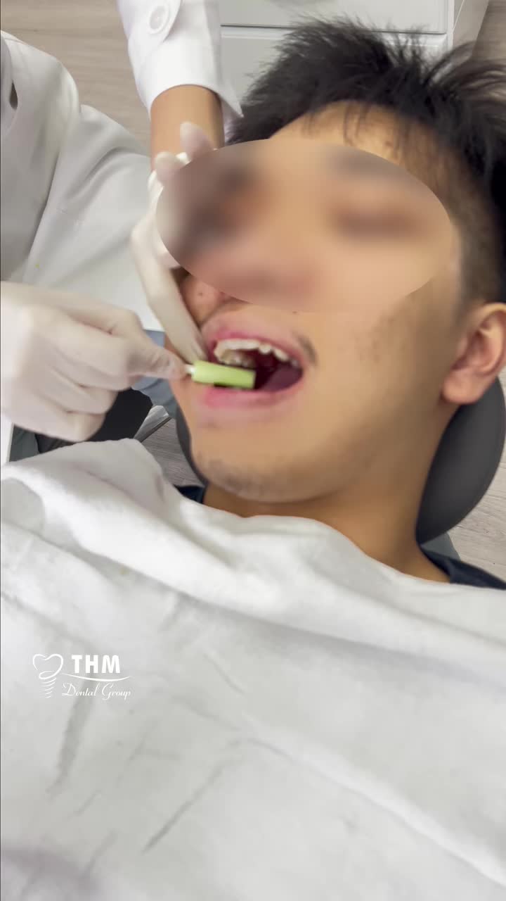 Tiếp tục hành trình niềng răng với khay trong suốt Invisalign lần đầu phần 2.