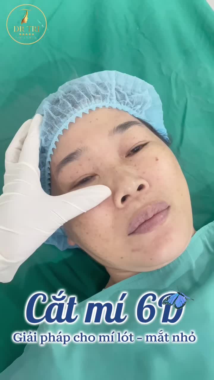 CẮT MÍ KHÔNG ĐAU - KHÔNG SẸO - TẠO 2 MÍ ĐẸP SẮC NÉT CHỈ SAU 30P