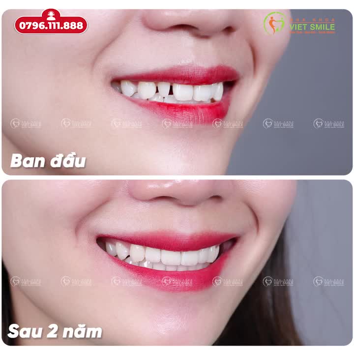 DÁN SỨ VENEER – KHẮC PHỤC RĂNG THƯA, BẢO TỒN RĂNG THẬT