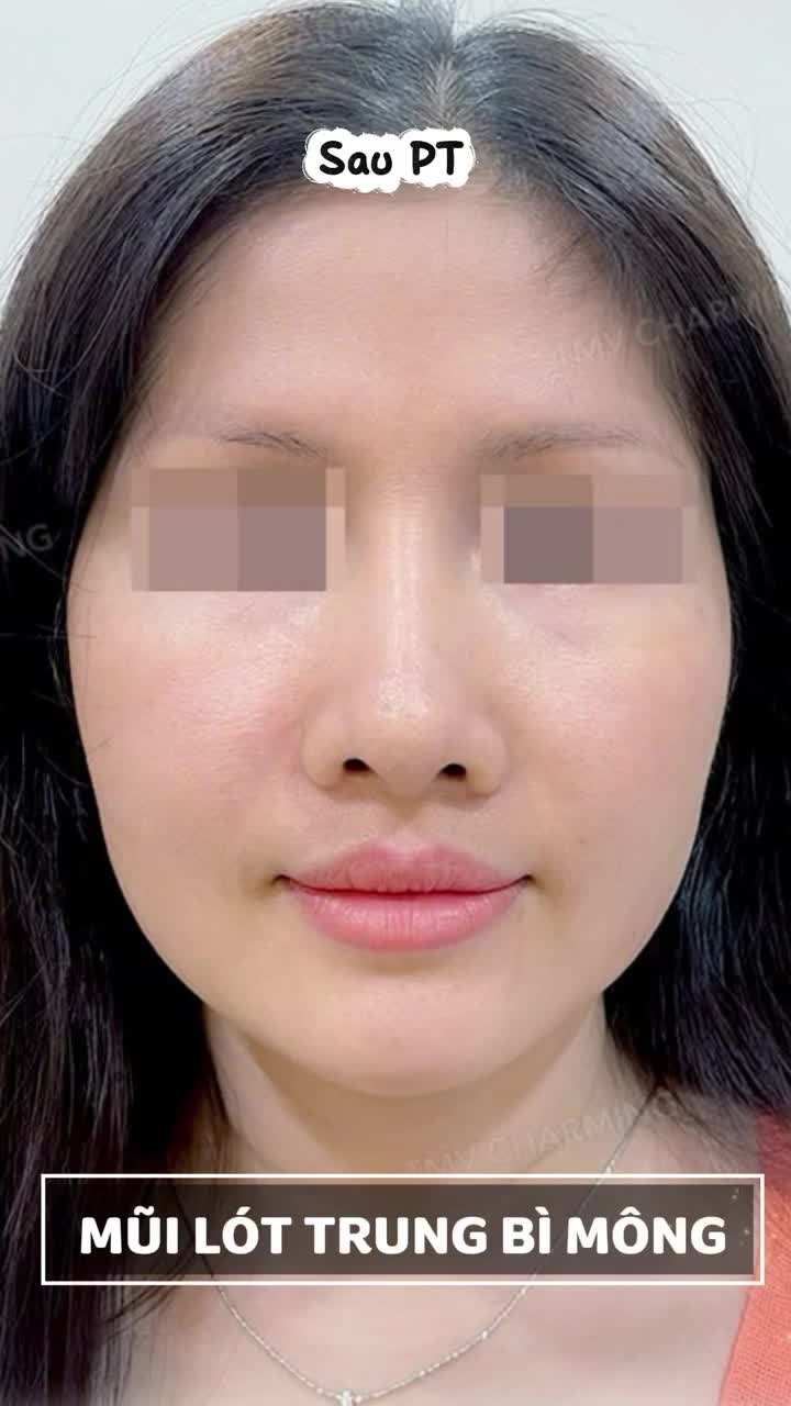 Sau 6 tháng nâng mũi tại Thẩm Mỹ Viện Charming - Bs Nguyễn Khanh với phương pháp lót cân mông đã khắc phục được các khuyết điểm của dáng mũi cũ.