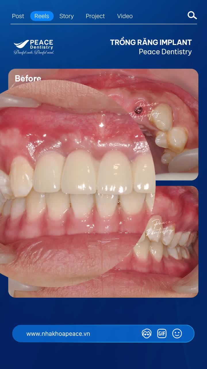 Thay thế răng mất bằng implant, bên cạnh việc khôi phục chức năng ăn nhai ổn định, tự nhiên và thẩm mỹ thì Implant còn là lựa chọn đầu tư bền vững.