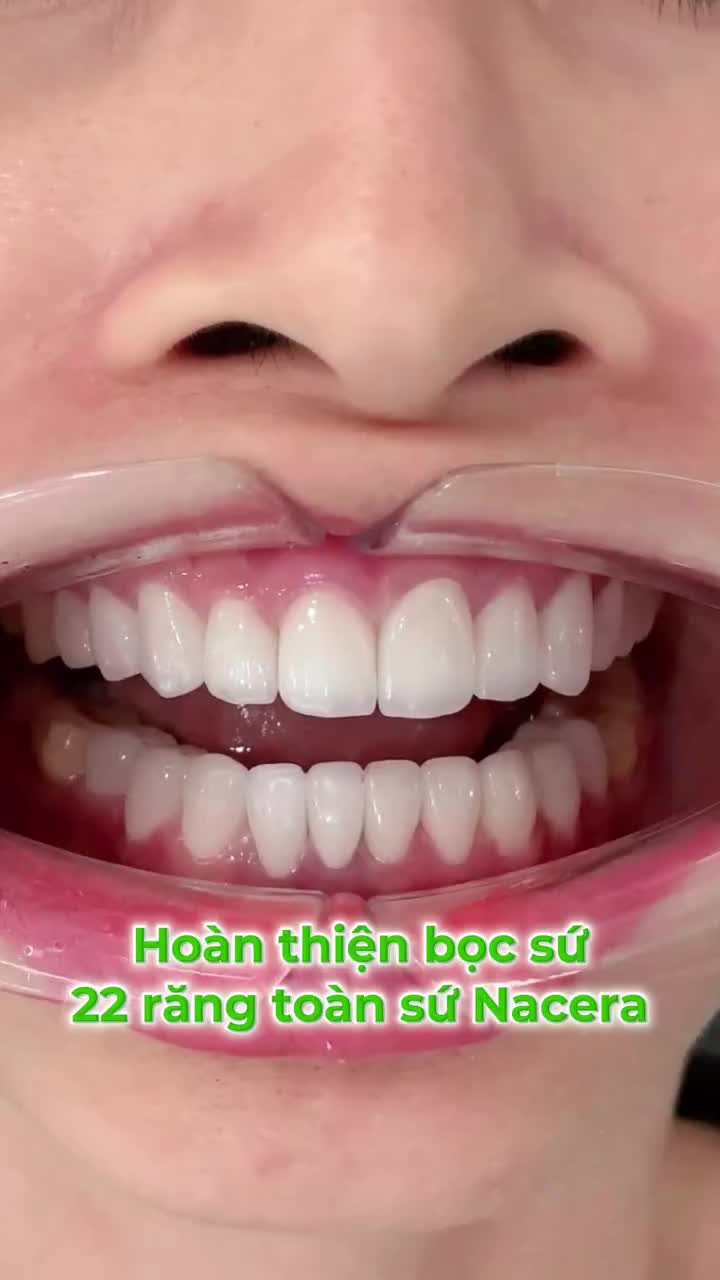 HOÀN THIỆN NỤ CƯỜI 22 RĂNG TOÀN SỨ NACERA – ĐẲNG CẤP TỪ CHẤT LIỆU ĐẾN TỪNG ĐƯỜNG NÉT