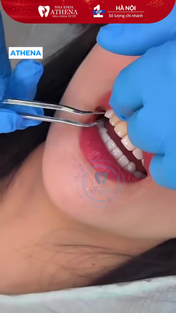 Bạn muốn thay đổi nụ cười nhưng sợ cảm giác mài răng  Bạn lo lắng bọc sứ sẽ làm nụ cười thiếu tự nhiên