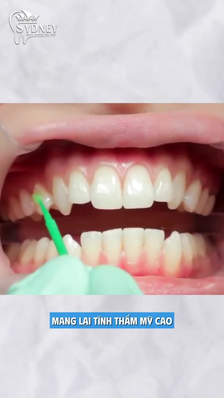 Những lưu ý khi niềng răng Invisalign