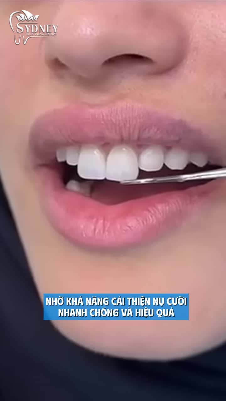 5 Lý do bọc răng sứ được ưa chuộng