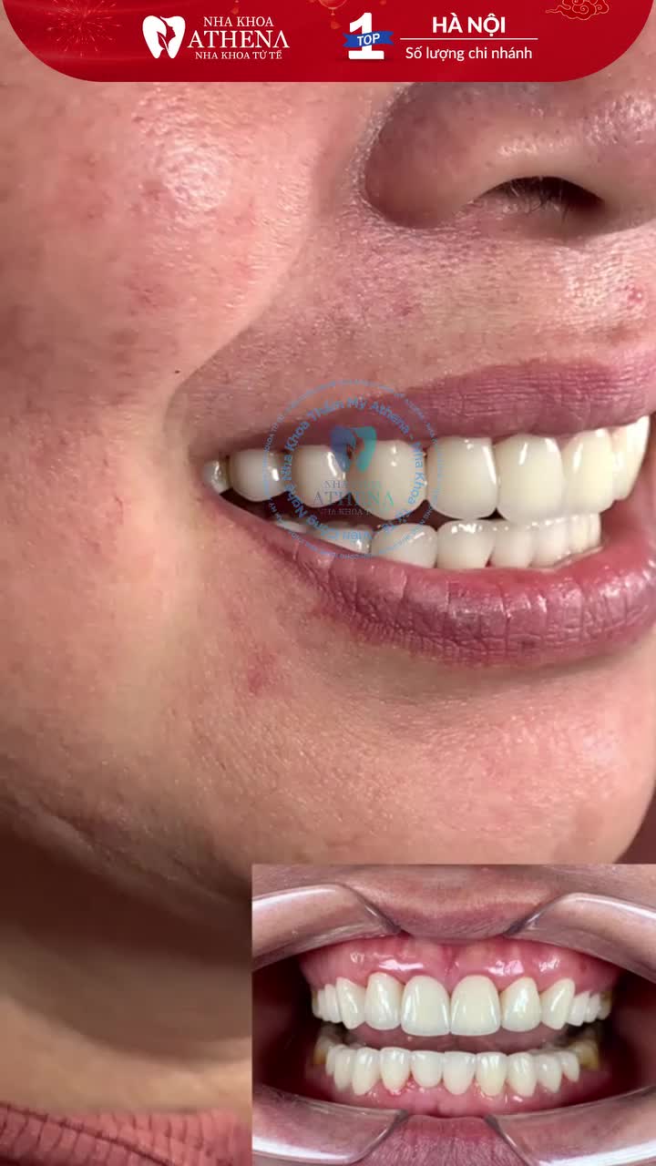 LÀM RĂNG SỨ CÓ ĐƯỢC CHỌN MÀU THEO Ý THÍCH?