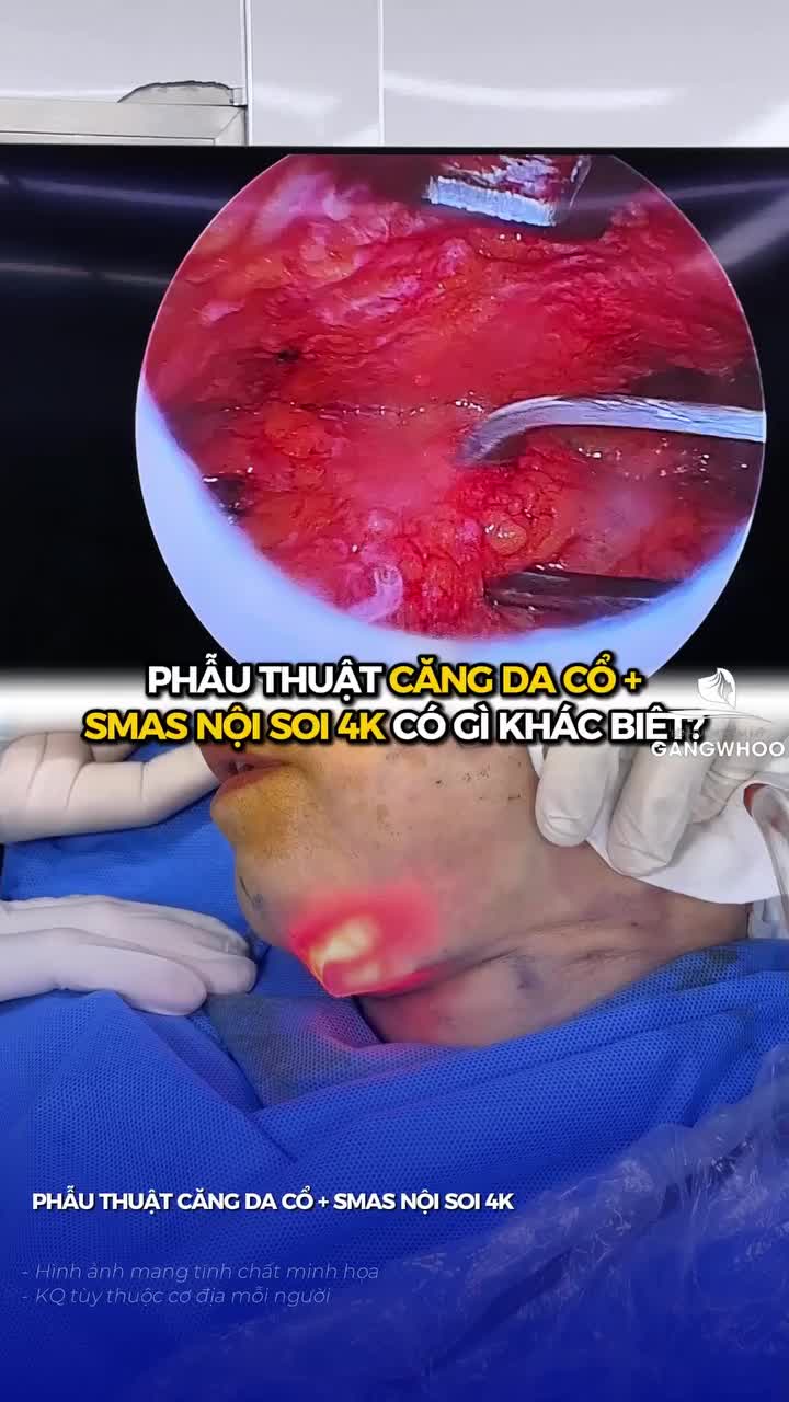 Phẫu trường căng da cổ Smas nội soi 4K tại BVTM Gangwhoo khác gì so với phương pháp thông thường