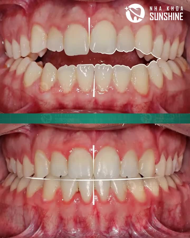 Niềng răng không chỉ để đẹp hơn, mà còn để: Ăn nhai tốt hơn Phát âm chuẩn hơn Giảm các bệnh lý răng miệng sau này