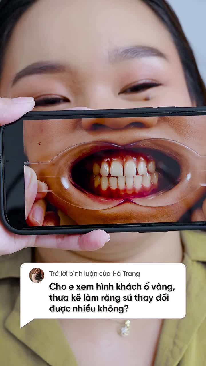 Cận cảnh kết quả bọc 16 răng sứ cao cấp Mỹ cho chị gái đón Tết sớm
