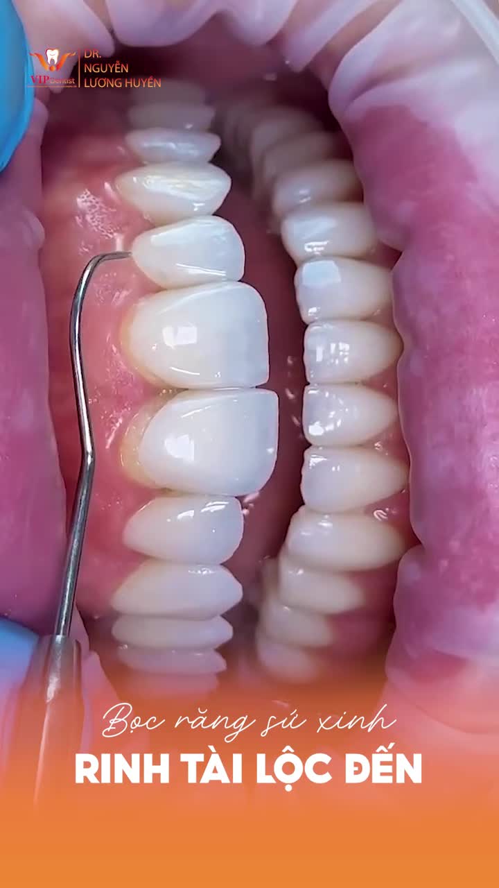 BỌC RĂNG XINH - RINH TÀI LỘC ĐẾN