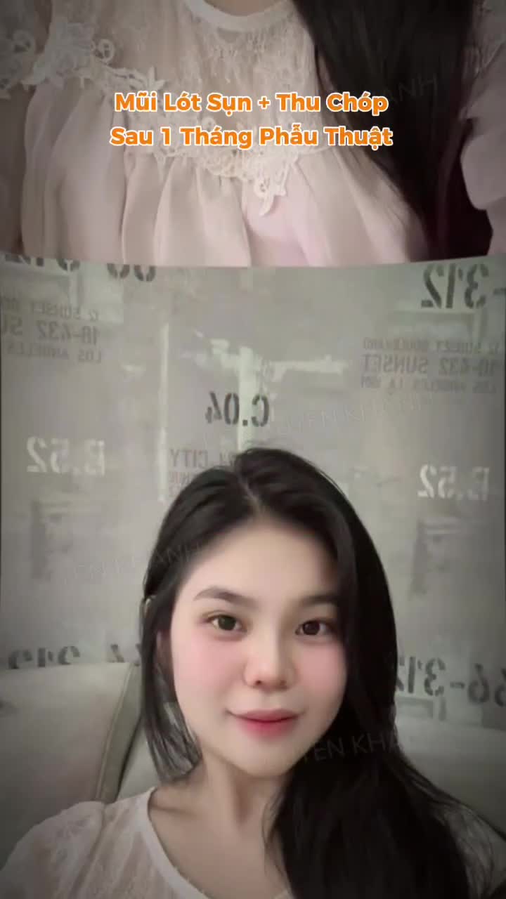 Mới một tháng sau khi thực hiện mũi lót sụn thu gọn chóp mà nàng đã “đỉnh của chóp” như vầy đây.