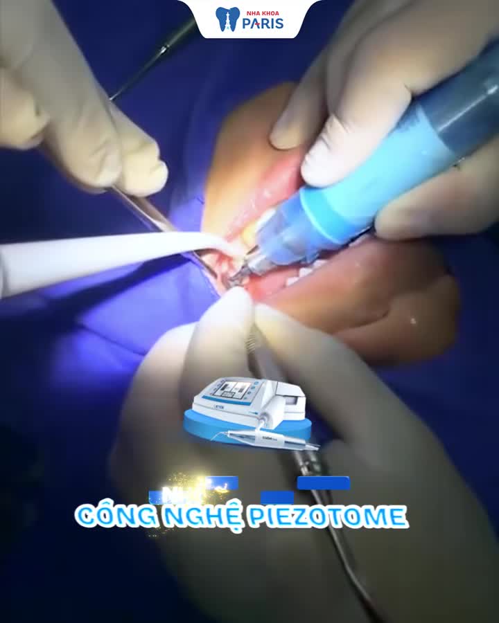 Sợ NHỔ RĂNG KHÔN vì đau và sưng húp mặt? Đừng để nỗi lo cản trở bạn tận hưởng cuộc sống!