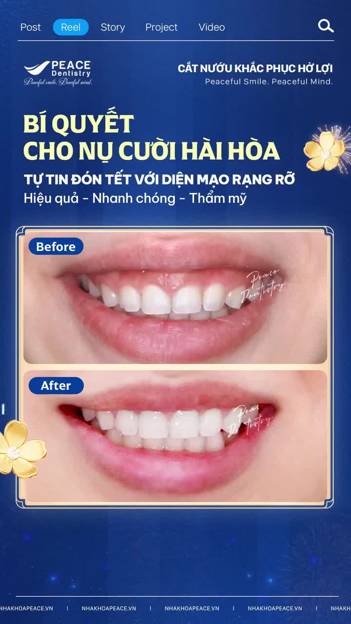 3 LÝ DO BẠN NHẤT ĐỊNH PHẢI CẮT NƯỚU KHẮC PHỤC HỞ LỢI TRƯỚC TẾT NÀY!