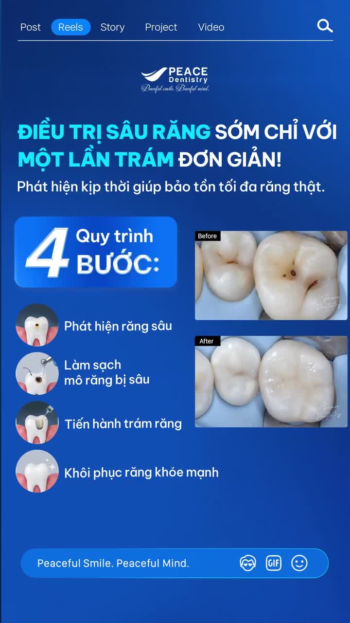 Điều trị sâu răng sớm giúp bảo tồn răng thật và tiết kiệm chi phí điều trị hơn khi tình trạng diễn biến nghiêm trọng.