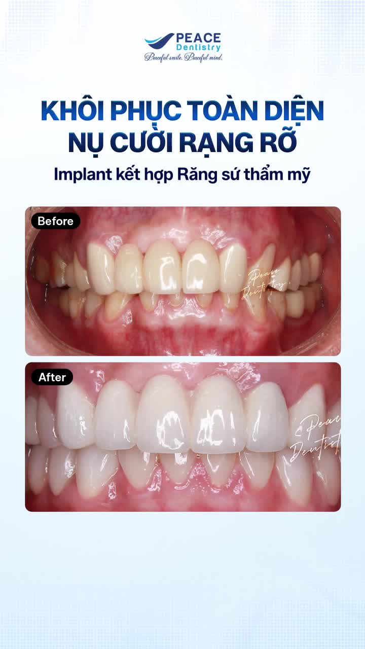 Nam khách hàng U60 đến Peace Dentistry với mong muốn cải thiện toàn diện nụ cười: