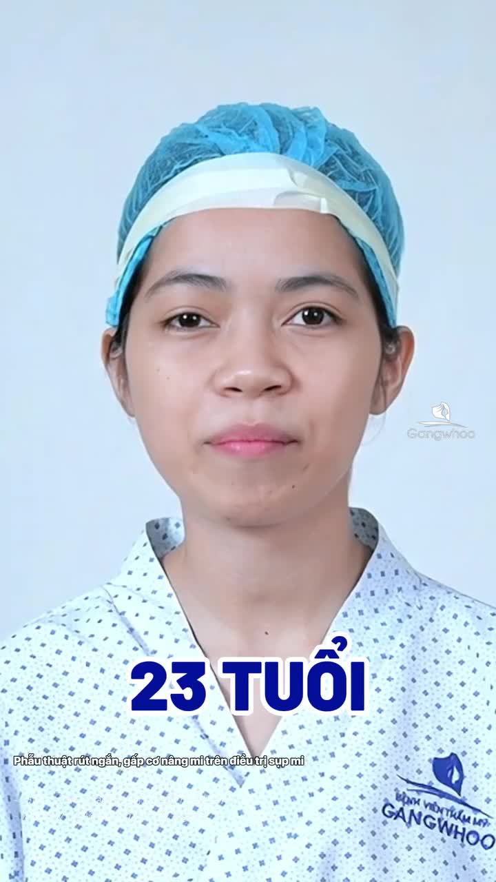 Khắc phục sụp cơ nâng mi sớm, trước khi tình trạng sụp mí trở nên nặng hơn.