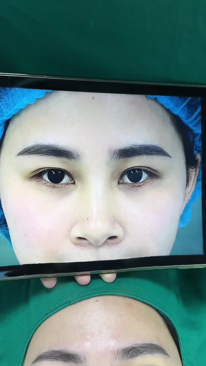 Thành quả một case "cứu" mí mắt sụp cho chị khách hàng tại Tấm