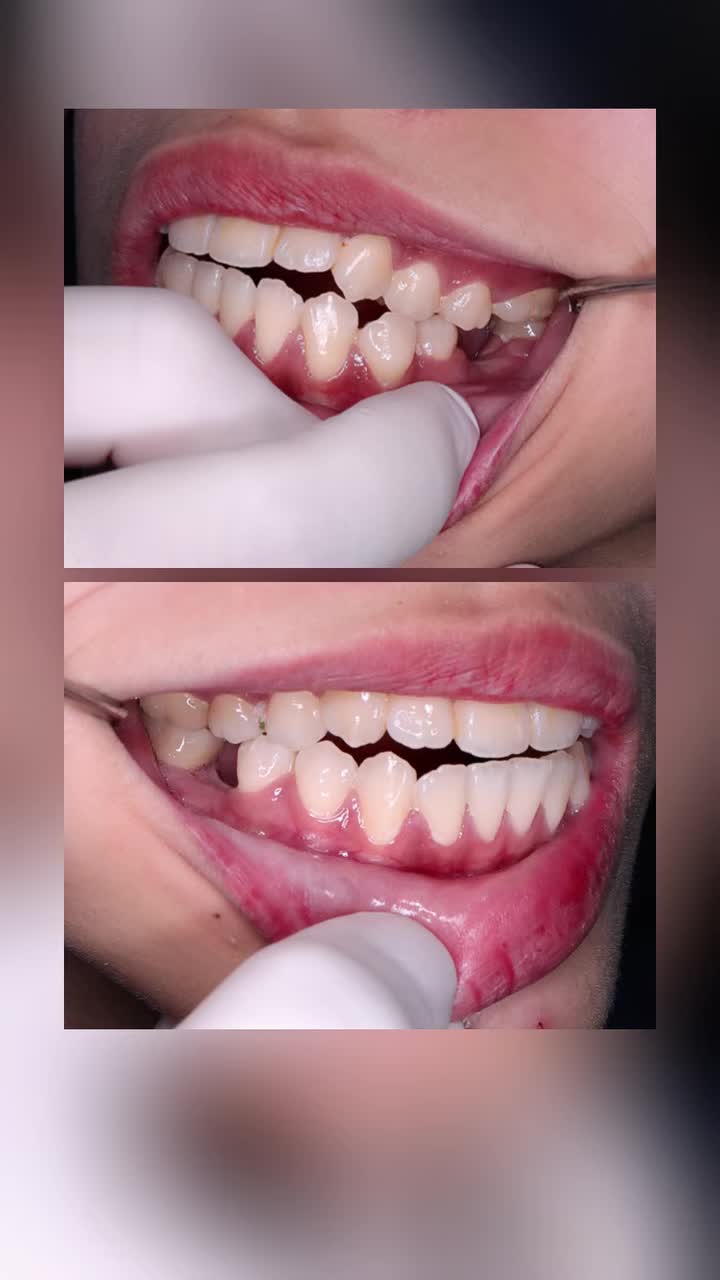 Mất răng 6 hệ luỵ như thế nào?