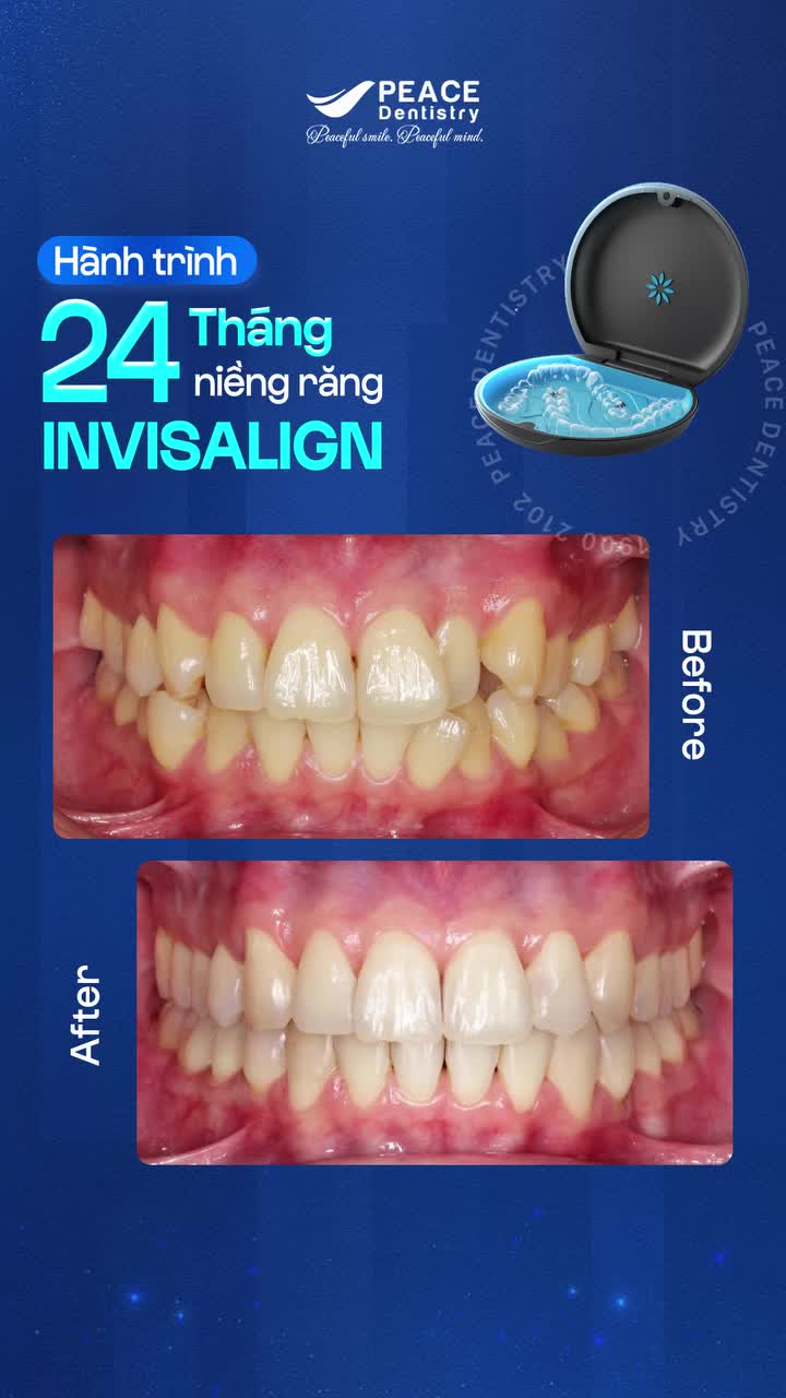 Hành trình 24 tháng điều trị Invisalign, cải thiện tình trạng: răng chen chúc do không đủ chỗ trên cung hàm xoay lệch gây mất thẩm mỹ, ảnh hưởng đến tiếp xúc giữa các răng khi ăn nhai.