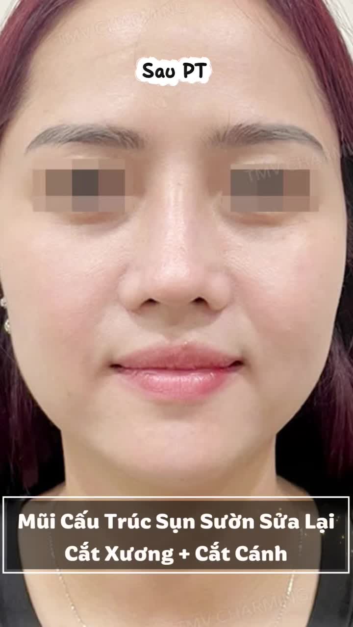 PHỤC HỒI NHAN SẮC: COMBO GIẢI CỨU DÁNG MŨI SỬA LẠI